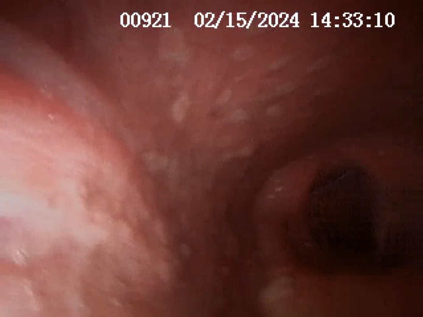 A still from an upper airway scope video